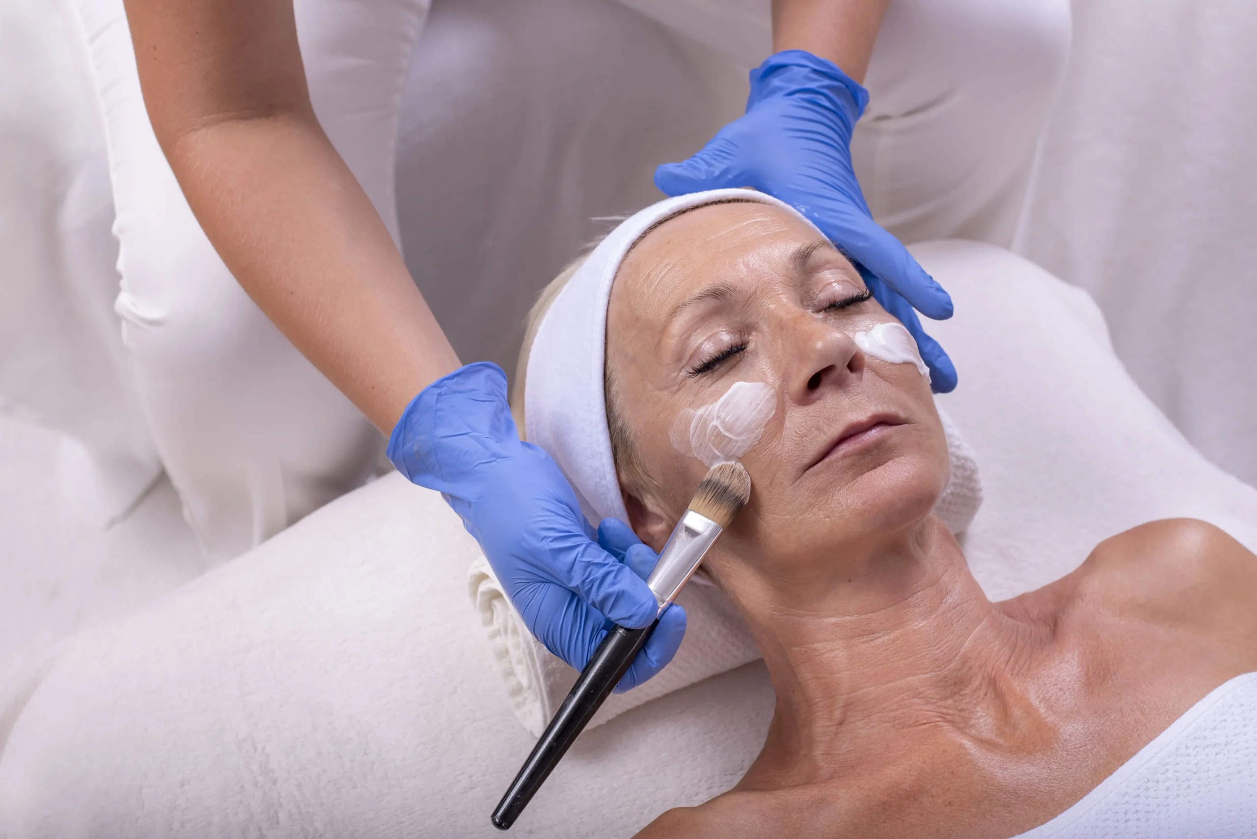 Peeling químico ou laser