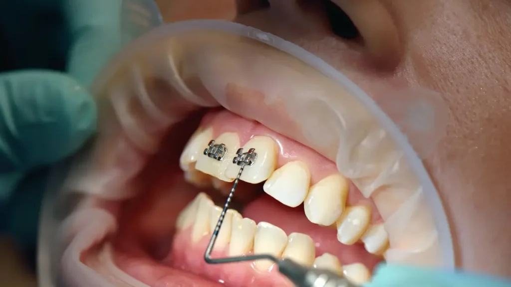 Colocar aparelho dental dói