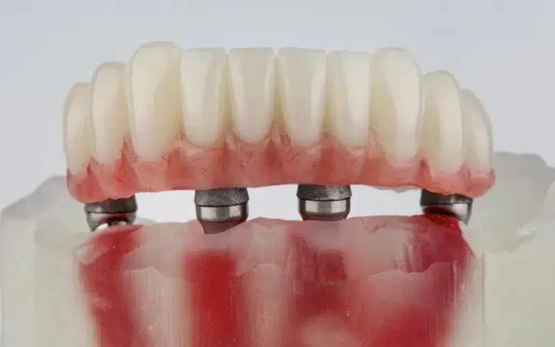 Prótese dentária é o mesmo que implante